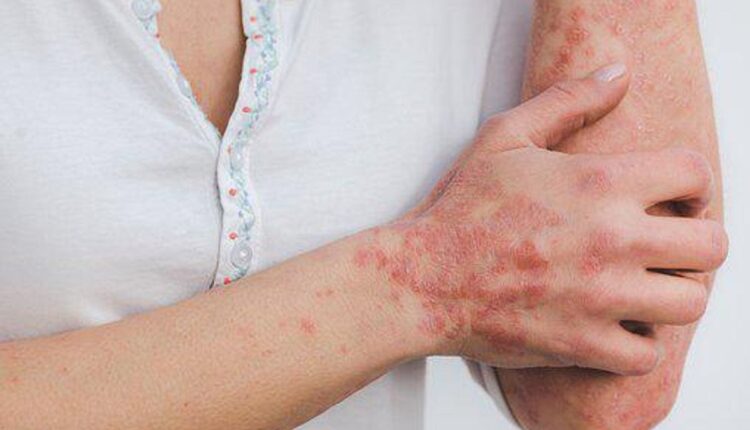 How To Cure Psoriasis